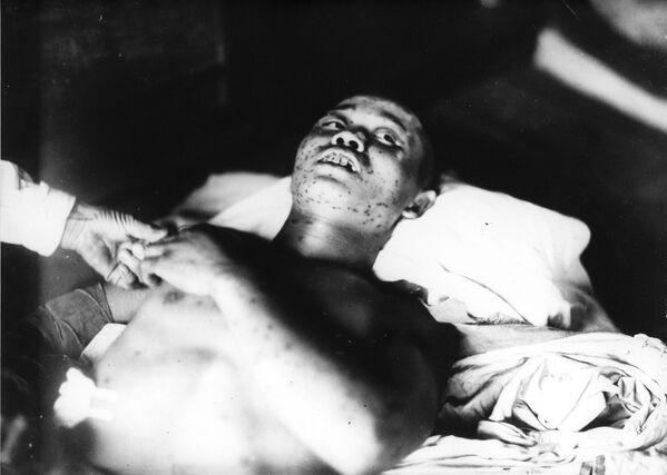 Victime du bombardement d’Hiroshima - Sputnik Afrique