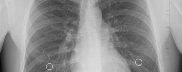 Poumons, image d'illustration - Sputnik Afrique