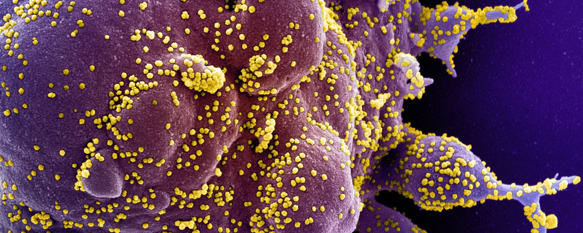 Une cellule infectée par des particules virales du SRAS-CoV-2 (en jaune) - Sputnik Afrique, 1920, 13.07.2021
