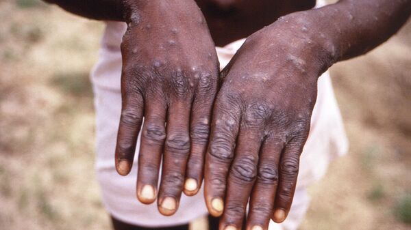 This 1997 image provided by the CDC during an investigation into an outbreak of monkeypox, which took place in the Democratic Republic of the Congo (DRC), formerly Zaire, and depicts the dorsal surfaces of the hands of a monkeypox case patient, who was displaying the appearance of the characteristic rash during its recuperative stage. The World Health Organization is convening its emergency committee  on Thursday, July 21, 2022 to consider for the second time within weeks whether the expanding outbreak of monkeypox should be declared a global crisis.  - Sputnik Afrique