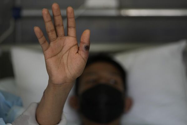 Au printemps et en été, des cas de variole du singe ont été recensés dans un certain nombre de pays. 80.000 personnes ont été infectées, selon les chiffres officiels, une trentaine sont décédées. Sur la photo: un patient souffrant de variole dans un hôpital de Lima, en Argentine. - Sputnik Afrique