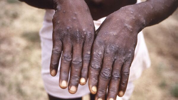 This 1997 image provided by the CDC during an investigation into an outbreak of mpox, which took place in the Democratic Republic of the Congo (DRC) depicts the dorsal surfaces of the hands of a mpox case patient. - Sputnik Africa