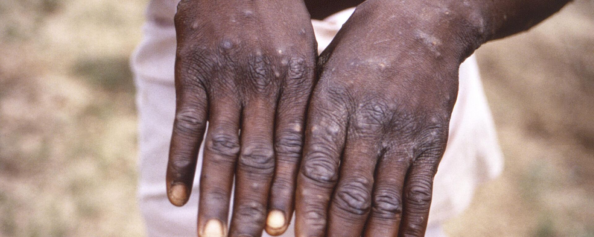 This 1997 image provided by the CDC during an investigation into an outbreak of mpox, which took place in the Democratic Republic of the Congo (DRC) depicts the dorsal surfaces of the hands of a mpox case patient. - Sputnik Africa, 1920, 21.08.2024