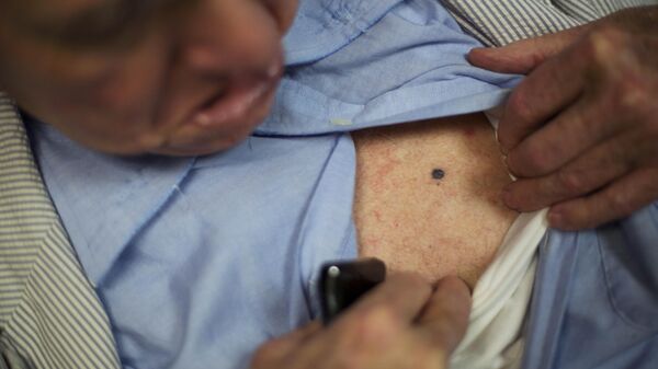 In this photo taken Aug. 27, 2015, John Jay Hooker shows a melanoma spot that has shrunk since starting treatment at Tennessee Oncology in Nashville, Tenn. - Sputnik Africa