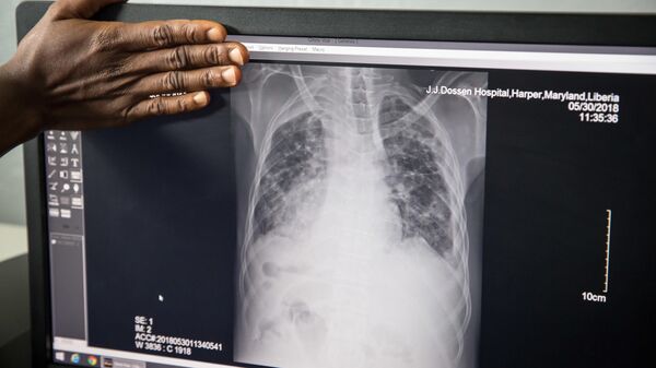 Tuberculosis - Sputnik Africa