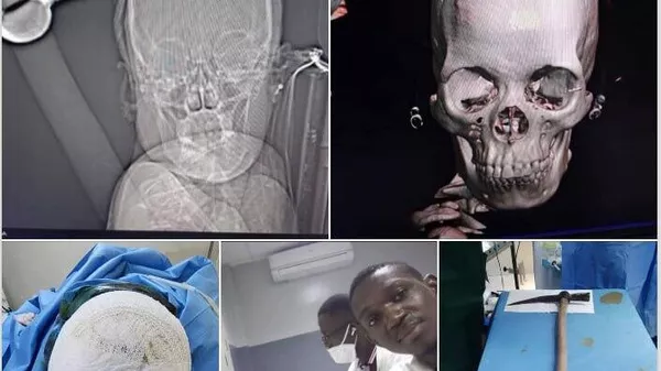 Une pioche dans la tête… et la vie qui l’emporte: l’incroyable résilience d'une jeune Africaine - Sputnik Afrique