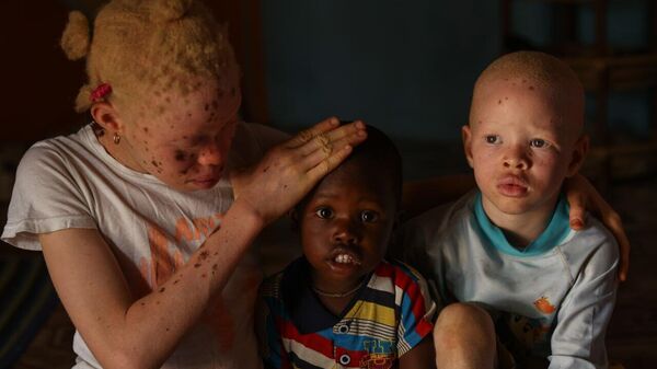 Shedding Light on Albinism: Fighting Stigma and Protecting Lives on International Albinism Awareness Day - Sputnik Africa