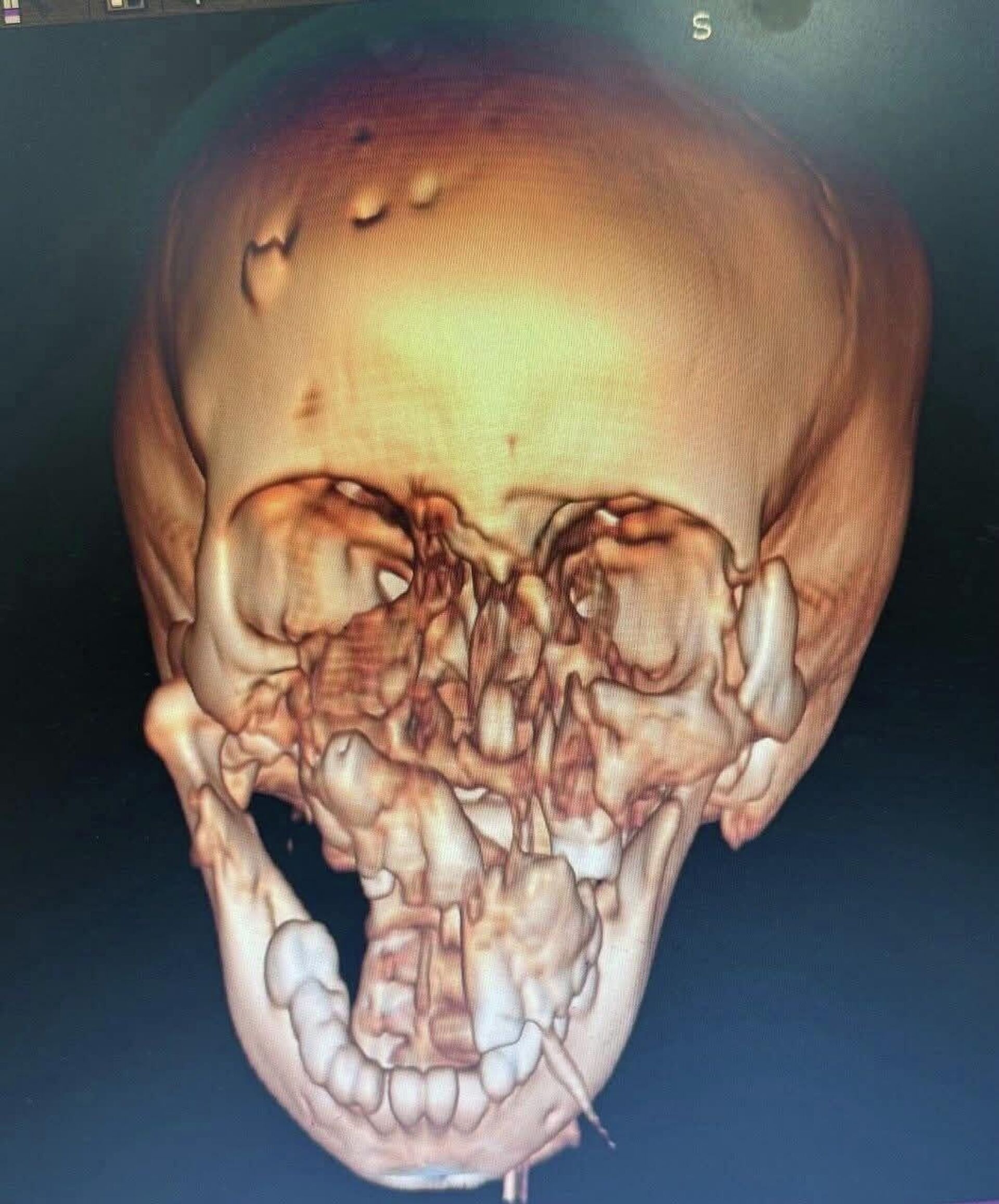 Un enfant défiguré par une hyène sauvé par des chirurgiens éthiopiens  - Sputnik Afrique, 1920, 26.03.2026