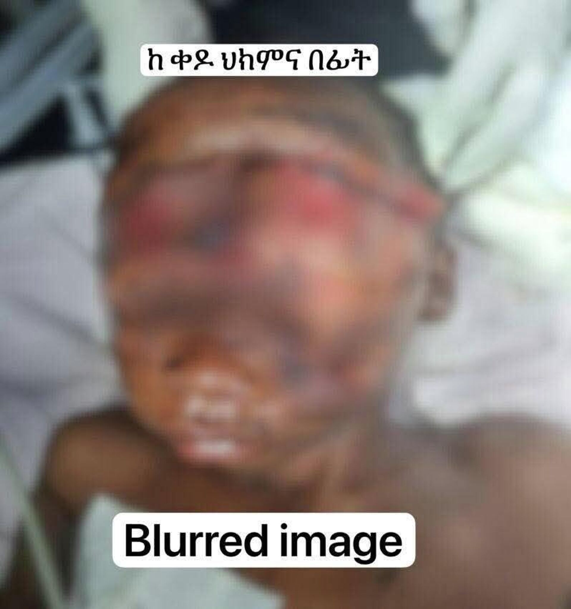 Un enfant défiguré par une hyène sauvé par des chirurgiens éthiopiens  - Sputnik Afrique, 1920, 26.03.2026