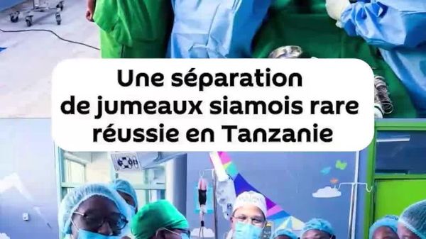 Une rare opération de séparation des jumeaux siamois réalisée en Tanzanie - Sputnik Afrique