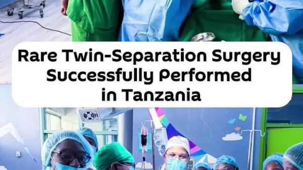 Tanzania's Surgeons Perform Rare Twin-Separation Surgery - Sputnik Africa