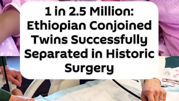 Ethiopian Conjoined Twins Get Chance at Normal Life After 25-Hour Separation Surgery - Sputnik Africa
