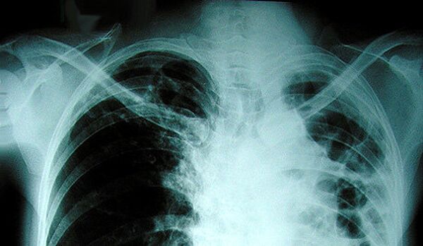 Tuberculose multirésistante : feu vert européen pour un nouveau traitement - Sputnik Afrique