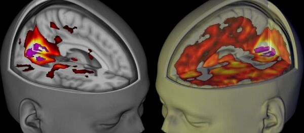 L'image montre le cerveau des sujets se trouvant éveillé, les yeux fermés, sous l'influence d'un placebo et du LSD lorsqu'ils sont examiné en utilisant l'IRM - Sputnik Afrique