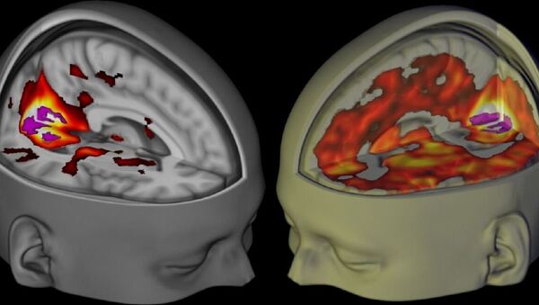 L'image montre le cerveau des sujets se trouvant éveillé, les yeux fermés, sous l'influence d'un placebo et du LSD lorsqu'ils sont examiné en utilisant l'IRM - Sputnik Afrique