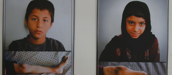 Scars of War: Images of Afghan Anatomy - Sputnik Afrique