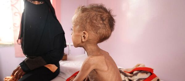 Les enfants yéménites sous-alimentés à cause de l'opération saoudienne Les enfants yéménites sous-alimentés à cause de l'opération saoudienne - Sputnik Afrique