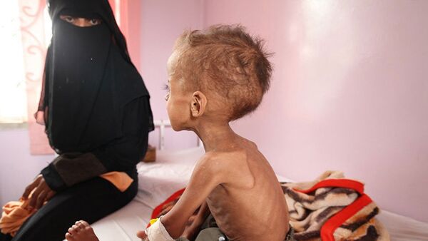 Les enfants yéménites sous-alimentés à cause de l'opération saoudienne - Sputnik Afrique