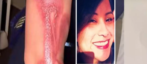 Elle s’endort avec son iPhone 7 et se réveille avec des brûlures du 2e degré - Sputnik Afrique