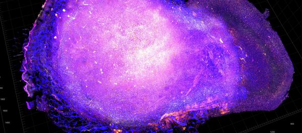 Anti-Tumor Immun - Sputnik Afrique