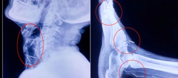 Les médecins découvrent dans son corps… 75 aiguilles! - Sputnik Afrique