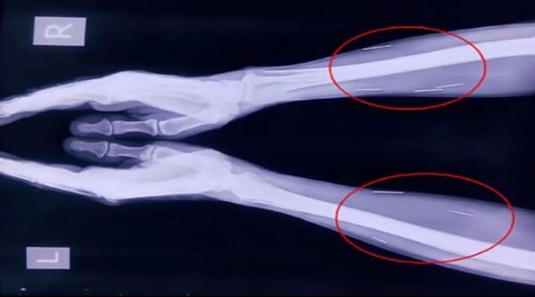 Les médecins découvrent dans son corps… 75 aiguilles!  - Sputnik Afrique