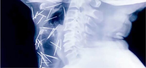 Les médecins découvrent dans son corps… 75 aiguilles!  - Sputnik Afrique