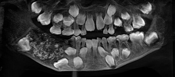 Снимок зубов 7-летнего мальчика из Индии L'inde dents l'anomalie une radio dentaire - Sputnik Afrique
