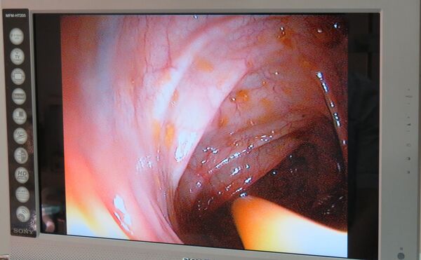 La transplantation fécale, un traitement d'avenir? La transplantation fécale, un traitement d'avenir? - Sputnik Afrique