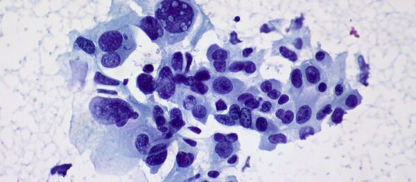 Cancer du poumon (image d’illustration) - Sputnik Afrique