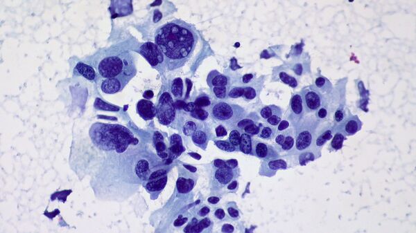 Cancer du poumon (image d’illustration) - Sputnik Afrique