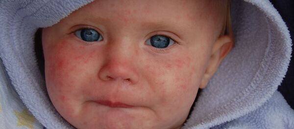 Rougeole (image d’illustration) - Sputnik Afrique