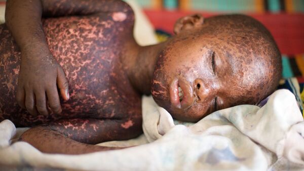 Un enfant atteint de la rougeole (archive photo) - Sputnik Afrique