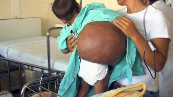 Une tumeur grosse de 15 kg extraite du corps d'un garçon de deux ans - Sputnik Afrique